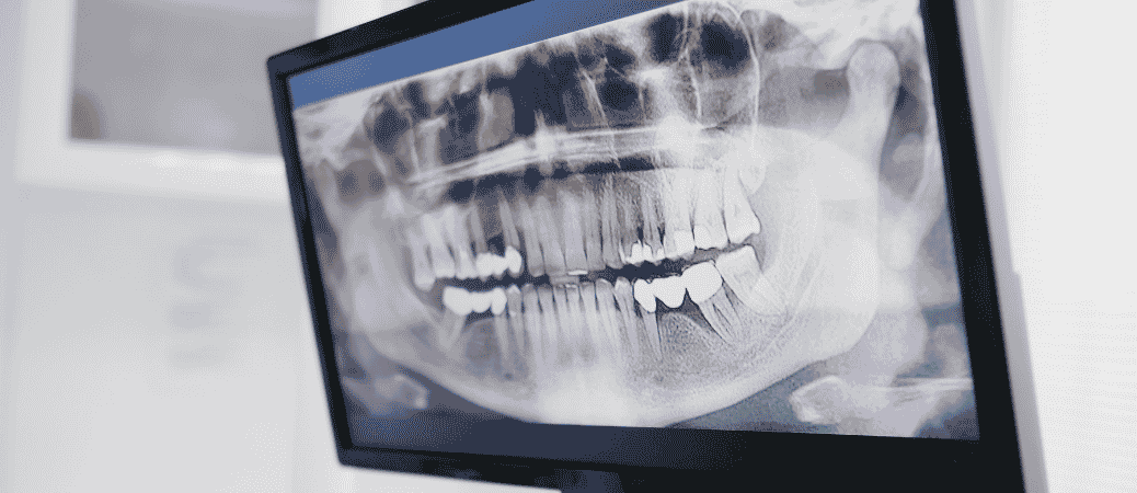 early signs of dental implant failure