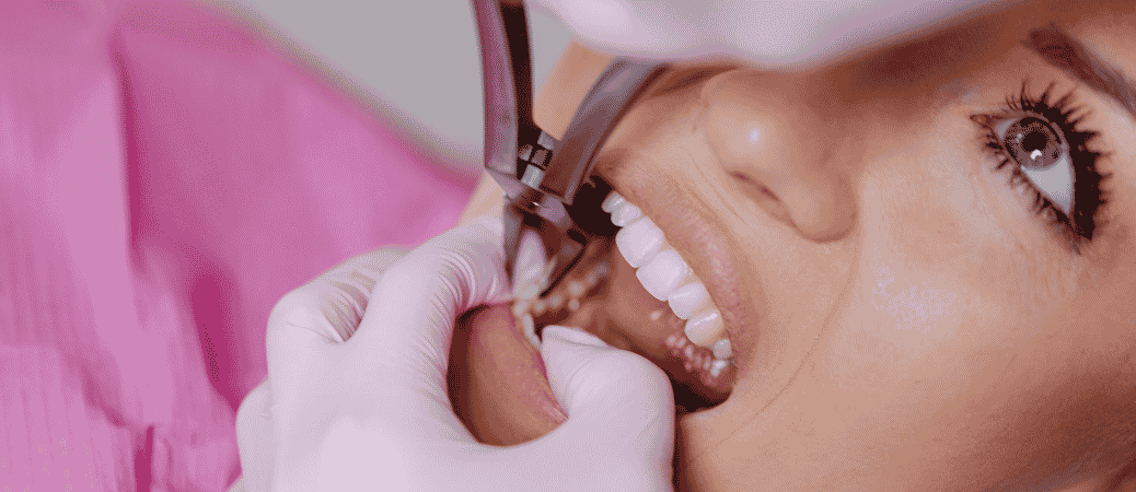 emergency tooth extraction