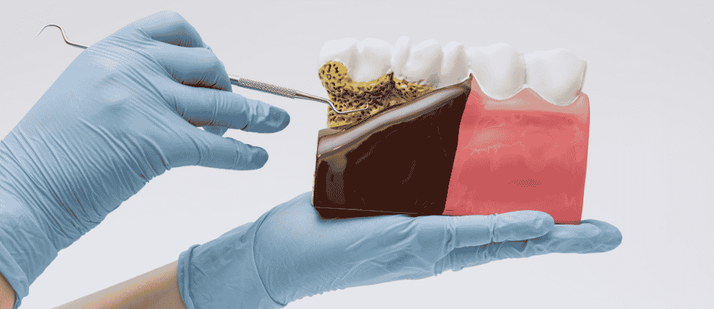 full mouth dental implant candidates